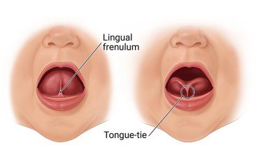 Short frenulum: what is it, symptoms and treatment