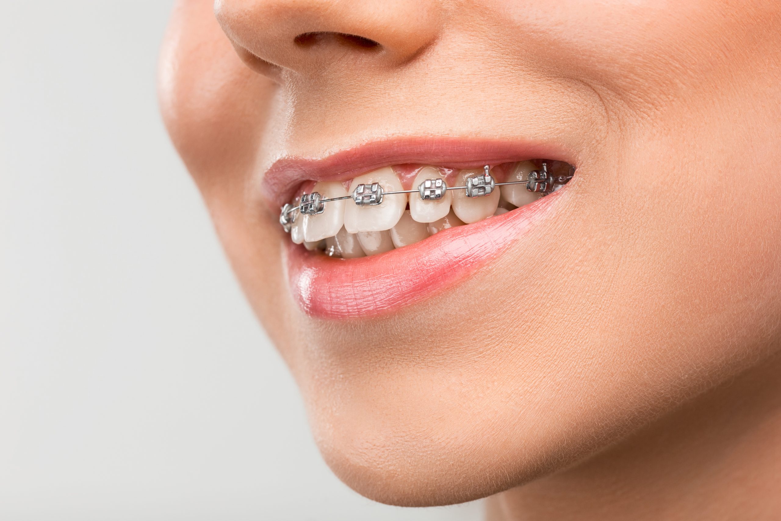Braces vs. Invisalign: Choosing the Right Fit for Your Smile