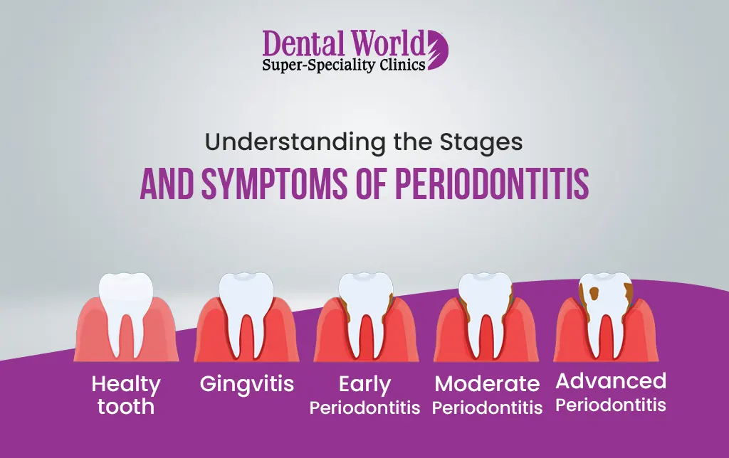 Understanding The Stages And Symptoms Of Periodontitis