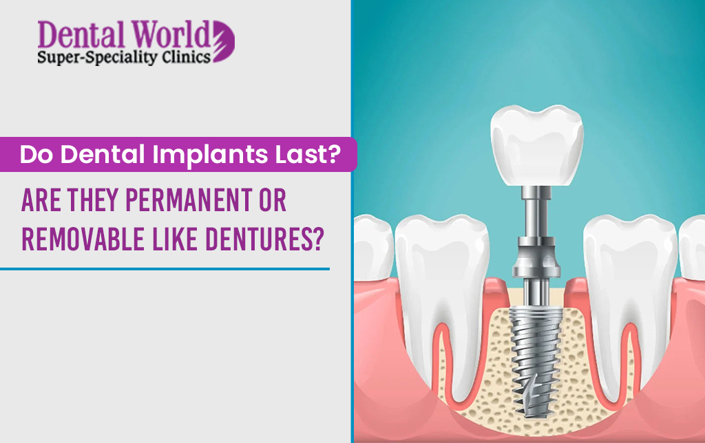 Do dental implants last Are they removable like dentures or do they stay in your mouth