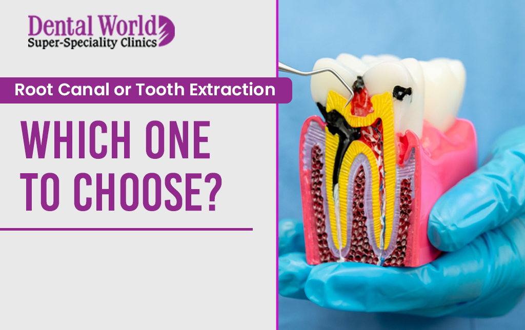 Root canal or tooth extraction – Which one to choose